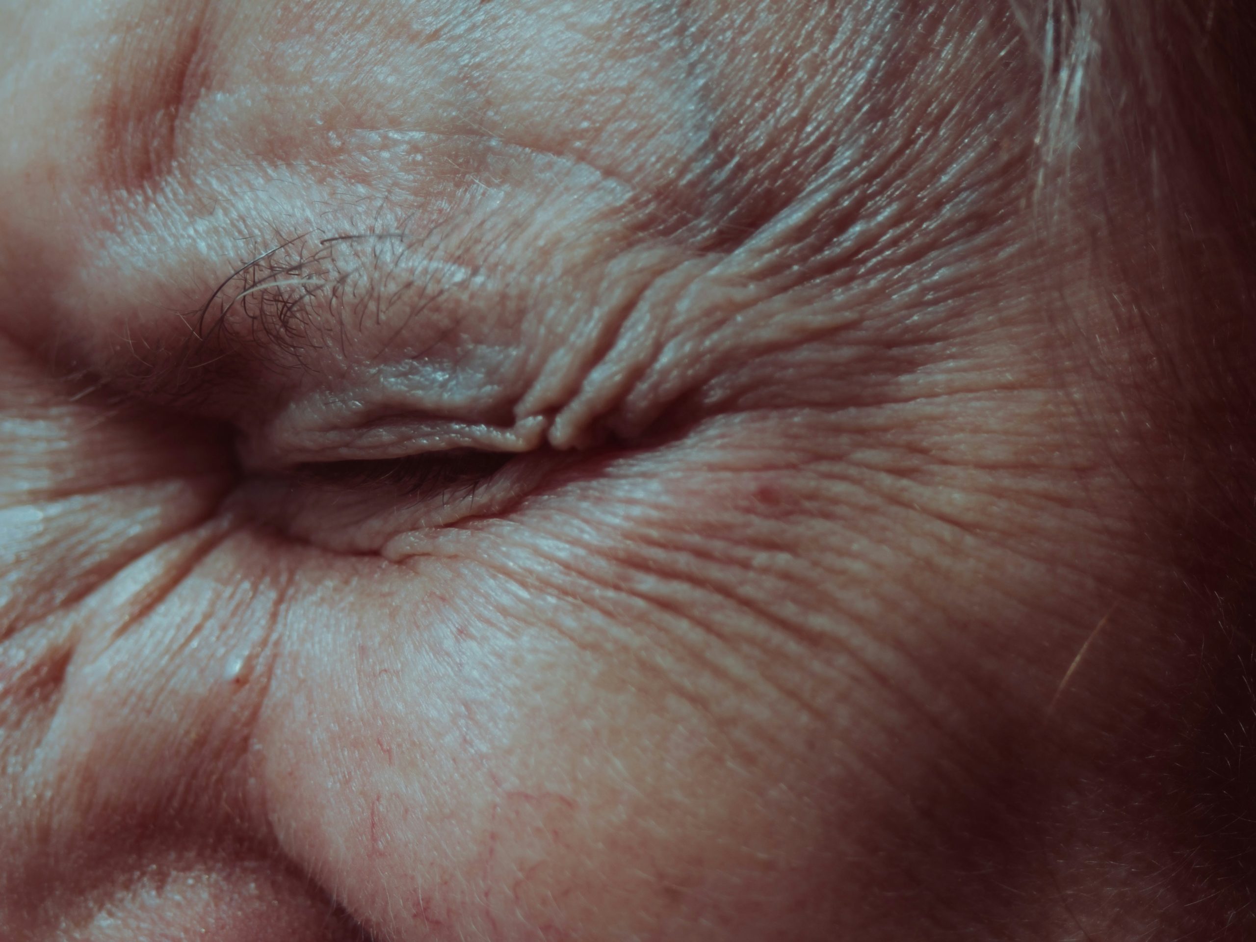 Facial expression showing dynamic wrinkle formation